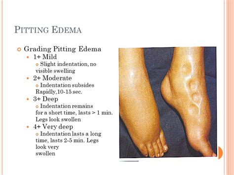 shin compression pitting edema test|pitting edema grade 2.